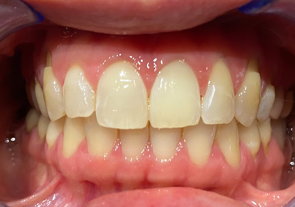 Studio Dentistico Labaro | Caso Sbiancamentovre